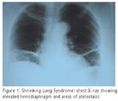 Shrinking Lung Syndrome In Systemic Lupus Erythematosus