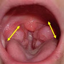 L'amygdalectomie est une opération réalisée pour enlever les amygdales. Ronflement Et Apnee Du Sommeil Dr Chhuor Chirurgien Orl Nantes