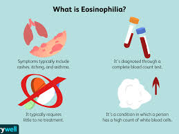 This can facilitate its complete cure by timely removal of precancerous growth. Eosinophilia Symptoms Causes Diagnosis Treatment