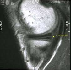 If your knee locks suddenly and will not unlock, get help and call your physician or go to your nearest emergency department. Torn Meniscus Uw Orthopaedics And Sports Medicine Seattle
