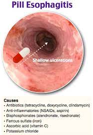 Rosh Review Gastrointestinal Nursing Gastroenterology Nursing Flashcards