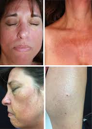 Diverse cutaneous manifestations of Erdheim-Chester disease in a woman with  a history of Langerhans cell histiocytosis