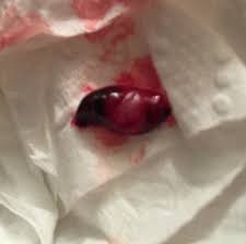 The timeline is very individual, and the not knowing may be unnerving to some people. Warning Graphic Picture Miscarriage Glow Community