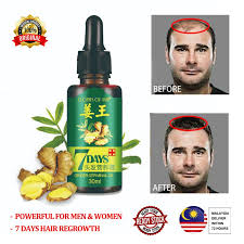 5 pack hair growth serum,ginger biotin hair regrowth oil prevent hair loss and natural serum for thicker, stronger, longer hair men and women. Original 7 Days Ginger Germinal Oil Hair Grow Hair Care Natural Hair Regrowth Serum Ginger Essential Oil Anti Hair Loss Shopee Malaysia