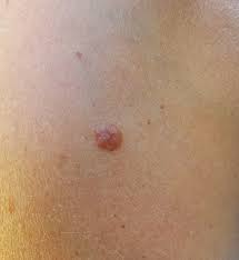 Image result for Solar Lentigo