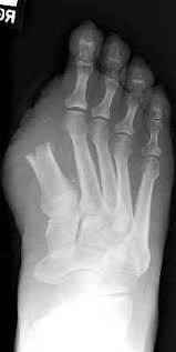 Image result for toe amputation