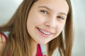 How long does it take for braces to straighten crooked teeth. Faster Than Other Straightening Treatments Fastbraces Dental Excellence Of Greenhaven Sacramento California