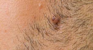 As new skin grows (the surface of your skin regrows at a rate than means you have a new top layer, aka epidermis, every two to four weeks), the dead skin comprising the ingrown hair is pushed away and. Ingrown Hair 6 Reasons You Re Getting Them Thehealthsite Com
