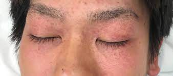 A hematoma is a collection of blood in the tissue outside of a damaged blood vessel, usually after an injury. Emesis Induced Facial Purpura As A Mask Phenomenon Bmj Case Reports