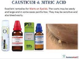Eye Lid Warts Get Rid With Homeopathy Homeopathy Medicine Homeopathic Treatment Homeopathy Remedies