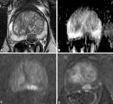 Mri is valuable in diagnosing many conditions … Improving The Diagnosis Of Clinically Significant Prostate Cancer With Magnetic Resonance Imaging