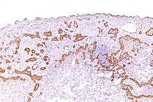 Less commonly the lining of the abdomen and rarely the sac surrounding the heart, or the sac surrounding the testis may be affected. Calretinin Wikipedia