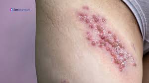 Image result for shingles