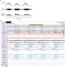 Image result for Cheyne-Stokes Respiration