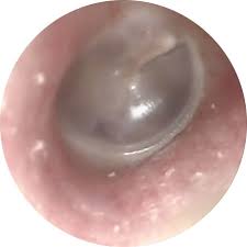 Ruptured eardrum,tinnitus and meniere disease and otitis media in asian woman. Ear Problems Ent Specialist Surgeon Adelaide Paul Varley Ent
