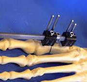 MINI RAIL ADJUSTMENT: Patient Education with Dr. Fragomen