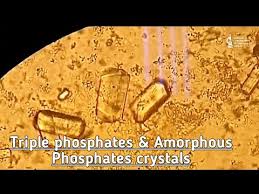 Triple Phosphate Amorphous Phosphates Crystal In Urine View At 10x 40 X Crystals In Urine Youtube