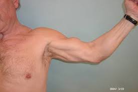Bizepssehnenriss Sportchirurgie Heidelbergsportchirurgie Heidelberg