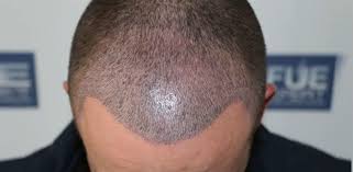 Tepe Bolgesi Sac Ekim Sonuclari Clinicexpert Com