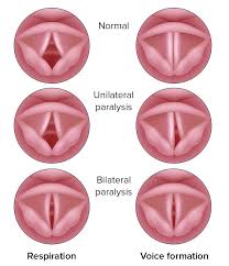 Image result for Vocal Cord Dysfunction