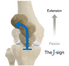 Image result for Patella Tracking Assessment