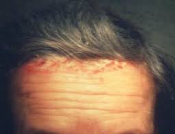 Check spelling or type a new query. Tratament Pentru Bube In Cap Despre ViaÈ›a Din Romania