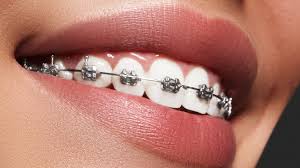 Get braces with me | cost $, recovery, supplies. Orthodontics Braces Mississauga Dr Gagan Bhalla Orthodontist