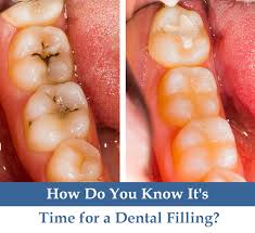 If your tooth aches when you drink hot drinks such as coffee or tea, this is a problem. How Do You Know It S Time For A Dental Filling