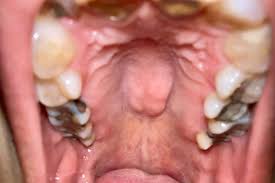 Image result for Canker sores symptoms roof of the mouth
