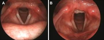 Image result for Chronic Laryngitis