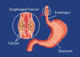 Esophageal Cancer:KUTRRH Delves into Research. – Kenyatta ...