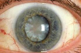 La catarata puede ocurrir en uno o en ambos ojos. Cambios Moleculares En El Cristalino Del Ojo Senales De Cataratas El Periodico Usa En Espanol Del Rio Grande Valley Texas