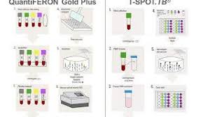The utility of an interferon gamma release assay for diagnosis of latent. Interferon Gamma Release Assays Aacc Org