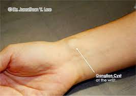 Tendon or joint stress might cause it, but it's not clear. Ganglion Cysts Dr Jonathan Lee Yi Liang