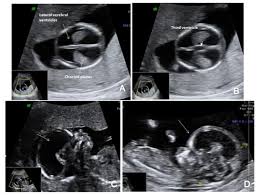 Image result for First Trimester Ultrasound