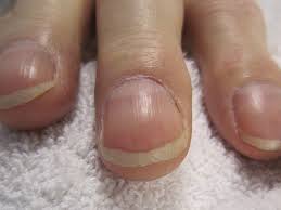 In addition to the dark nail polish, another reason that most people do not see this first sign is that it happens to people who have dark skin. Nail Clubbing Definition Causes And Diagnosis