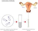 Insemination artificielle france