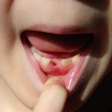 Check spelling or type a new query. Braces And Missing Teeth Orthodontic Associates