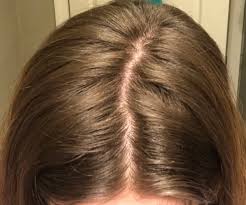 It's not uncommon to experience an itchy scalp and hair loss together. Daily Shedding With High Dheas What Should I Be Doing Donovan Hair Clinic