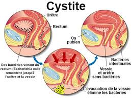 Traitement minute, en 1 seule prise cystite aigüe non compliquée (diabète, immunodépression, récidives multiples…) Cystite Symptomes Traitement Definition Docteurclic Com