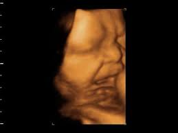 Crying Baby Inside Womb Usg 4d By Dr Ivander Utama F Mas Spog