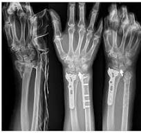 Treatment of the Distal Forearm Fracture by Volar Dual ...