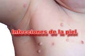Que Son Las Infecciones De La Piel Clinica Hispana Harrisburg