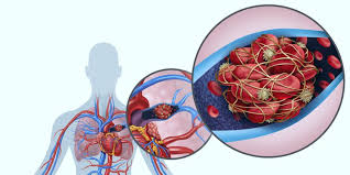 Cómo detectar y prevenir la trombosis venosa profunda cuando el coágulo crece. Embolia Pulmonar Sintomas Prevencion Y Tratamiento