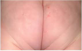 Imagenes De Dermatitis Del Panal Leve A Grave Desitin