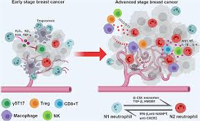 Inflammatory breast cancer is so named because the skin changes in this are similar to skin changes that occur when inflammation occurs in the setting symptoms include breast swelling, purple or red color of the skin, and dimpling or thickening of the skin of the breast so that it may look and feel like. Frontiers A Rosetta Stone For Breast Cancer Prognostic Value And Dynamic Regulation Of Neutrophil In Tumor Microenvironment Immunology