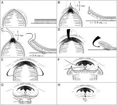 Image result for Umbilicus botryoides