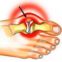 как понизить мочевую кислоту в крови в домашних условиях Life Without Bunions How To Get Rid Of Them In 2 Months Bunion Health And Beauty Health