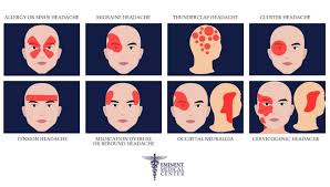 Image result for Acute Localized Headache