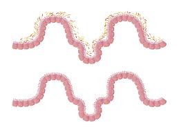 Umhs experience fmt has been utilized in patients with rcdi at umhs with good success. What Would It Take To Make Fmt Mainstream Two Publications Consider The Opportunities